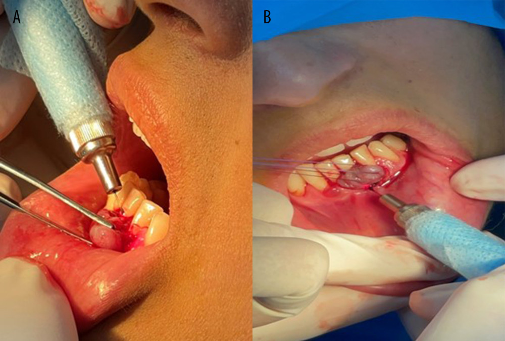 (A, B) Photographs taken during diode laser surgical excision of the lesion.