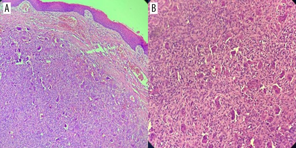 (A, B) Histological examination (hematoxylin and eosin stain) shows proliferation of multinuclear giant cells in the stroma formed by fibroblasts, blood vessels, and chronic inflammatory infiltrates.