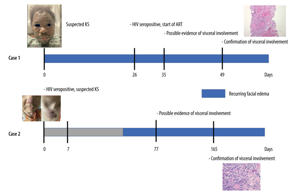 American Journal of Case Reports AIDSRelated Kaposi
