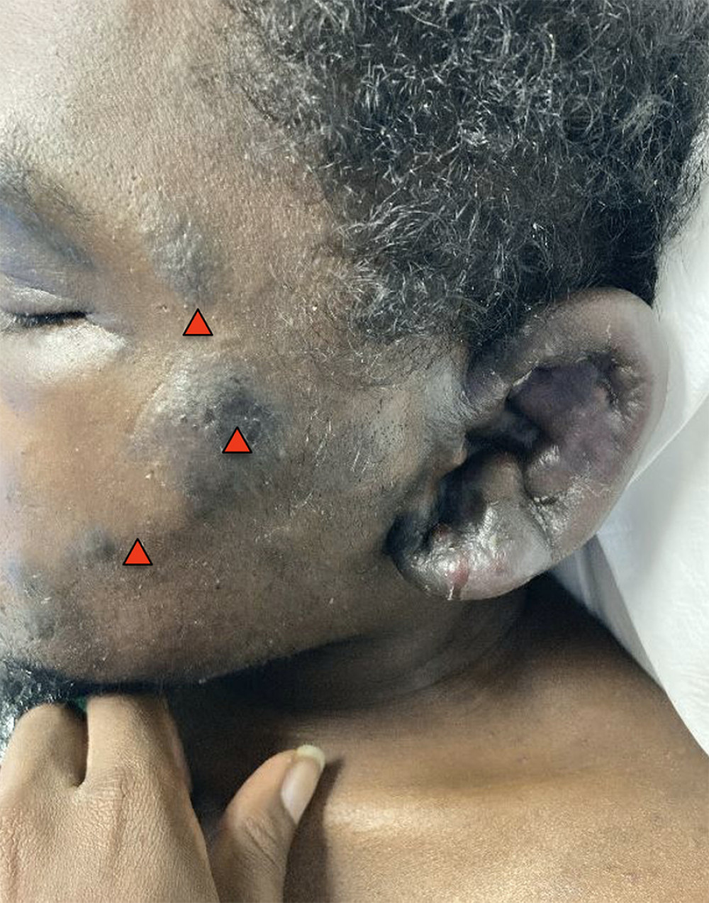 Kaposi sarcoma lesions (red arrowheads) and facial edema.