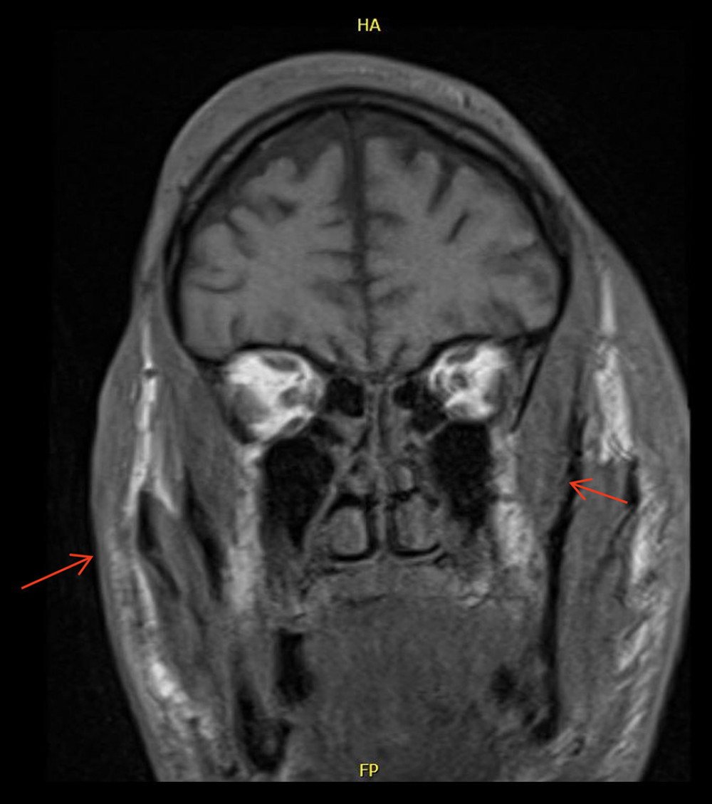 MRI T1-weighted image, coronal view. Diffuse infiltrative lesions throughout the skin and subcutaneous tissues of the head (red arrow) and visualized portion of the neck, including upper cervical lymphadenopathy and left buccal mucosa (not shown).