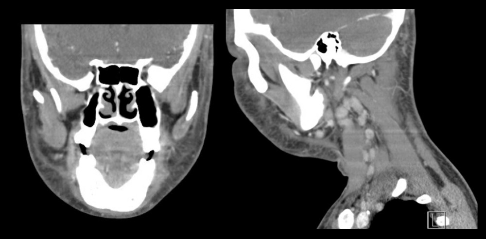 CT of the neck, with contrast, coronal and sagittal views. Reduction of the right peritonsillar abscess, now approximately 12×13 mm, along with persistent moderate edema involving visualized soft tissue structures (scalp, face, neck, and laryngeal structures, and upper chest) and epiglottal thickening.