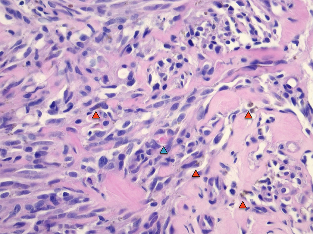 Right axilla biopsy (hematoxylin-eosin staining, 400×). The section shows a spindle cell neoplasm with subtle vascular proliferation comprised of small slit-like vessels lined by mildly atypical spindle cells. Scattered hemosiderin deposits (dark brown structures, red arrowheads) and a single focus of intracellular hyaline globules (blue arrowhead) are visible. Immunohistochemical stains (not shown) were positive for ERG and HHV-8.