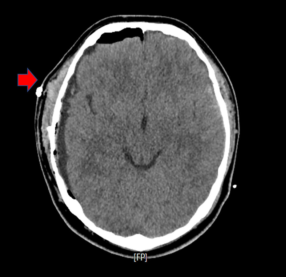 Computed tomography (CT) imaging of the patient`s brain. A large epidural hemorrhage appears in the right cerebral convex region. Linear fractures and midline shifts of the right parietal and right temporal bones are shown. Also seen is a small intracerebral hemorrhage and contusion in the left temporal lobe.