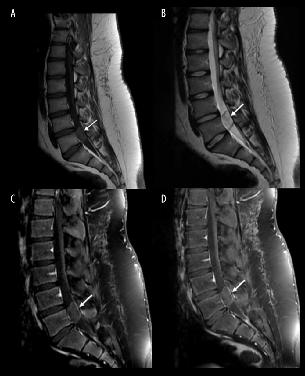 Sagittal MRI sections. White arrows point to the lesion. (A) Sagittal MRI T1-weighted image without contrast shows a well-defined hypointense intradural extramedullary cystic lesion (solid arrow) at the Level of L5. (B) T2-weighted image shows hyperintensity of the lesion. (C) T1-weighted image with contrast and fat suppression show no enhancement of the lesion. (D) T1-weighted image delayed imaging shows no enhancement.