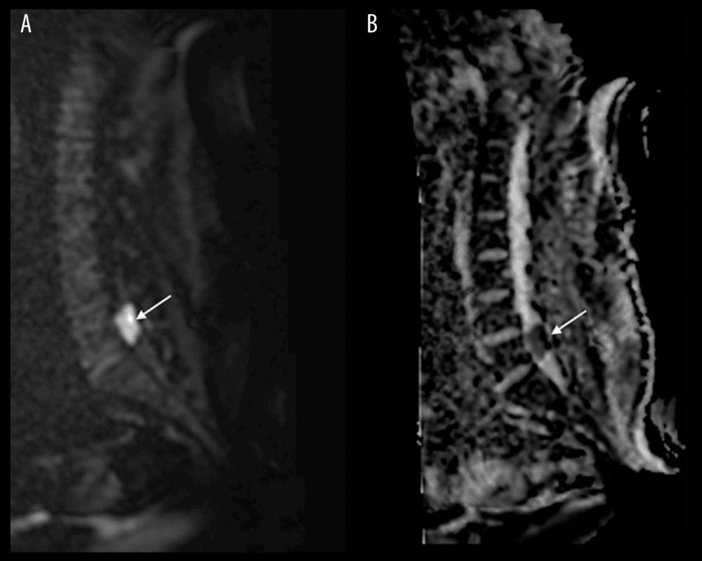 (A) Diffusion-weighted imaging. (B) Apparent diffusion coefficient (ADC). White arrows point to the lesion. (A) The lesion demonstrated restricted diffusion on DWI. (B) ADC (Apparent diffusion coefficient) is consistent with epidermoid cyst.
