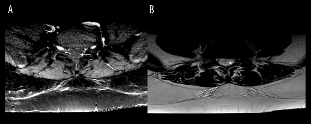 MRI Axial view. White arrows point to the lesion. (A) Axial T1-weighted image post contrast MRI shows the intradural extramedullary lesion along the cauda equina nerve roots without significant post contrast enhancement. No extension along the bilateral neural foramina. (B) Axial T2-weighted image shows hyperintense signal of the lesion.