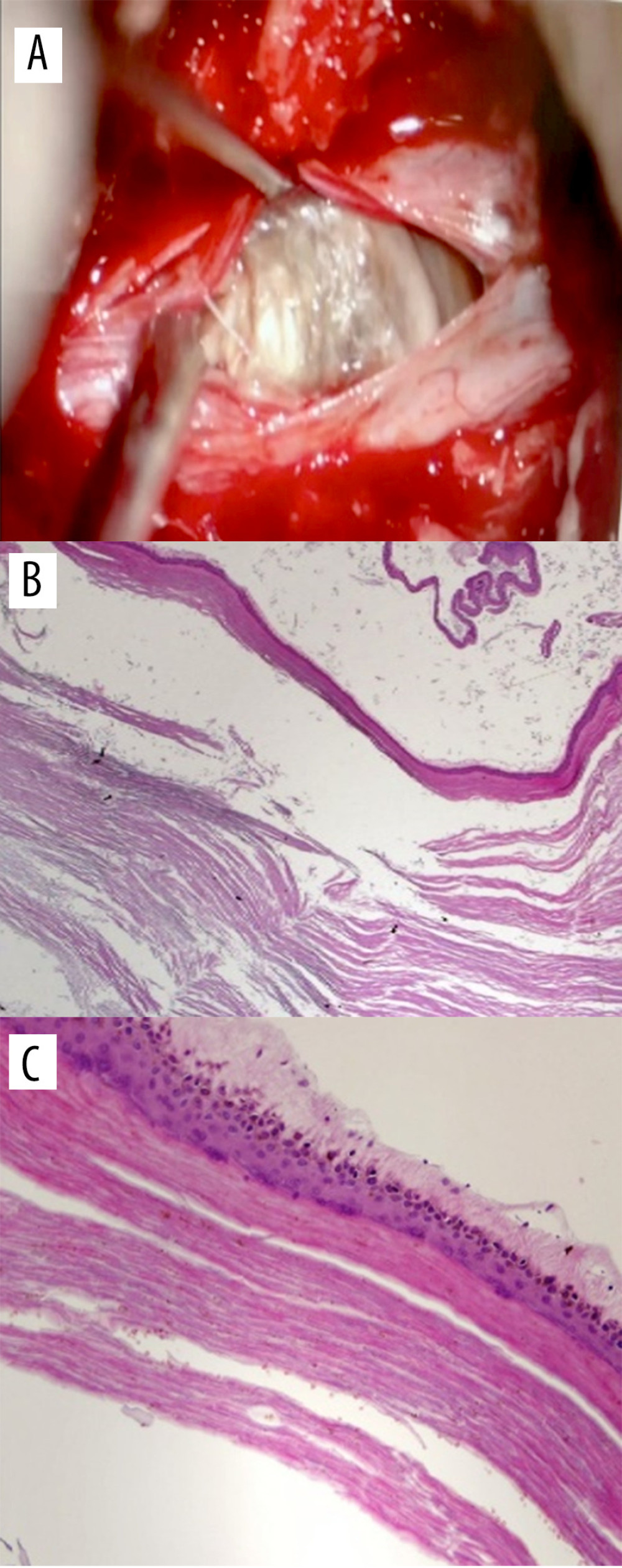 (A) Gross picture of the lesion during surgery. The pathology report described the lesion grossly as a white tan friable soft tissue measuring 5×4×1 cm. (B) Low-power view shows cyst containing lamellated keratin material (original magnification ×20, H/E stain). (C) High-power view reveals cyst lining of stratified squamous epithelium with granular cell layer (original magnification ×200, H/E stain).