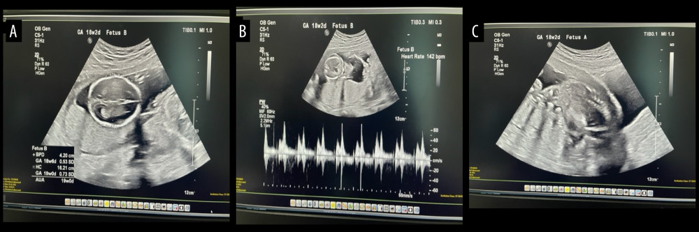Obstetrical ultrasonography done on admission for the patient with a twin gestation and an abdominal cerclage; (A, B) fetus B seen with normal anatomy and positive fetal heart rate; (C) fetus A with distorted anatomy and negative fetal heart rate.