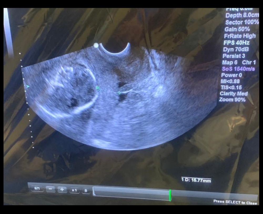 Transvaginal ultrasound showing an umbilical cord protrusion out of the cervical canal of the presenting fetus of the patient in question.