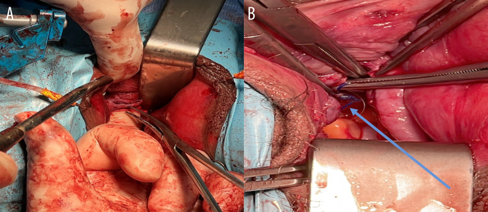 Intraoperative pictures showing (A) the posterior knot colpotomy approach and (B) posterior knot cerclage suture removal.