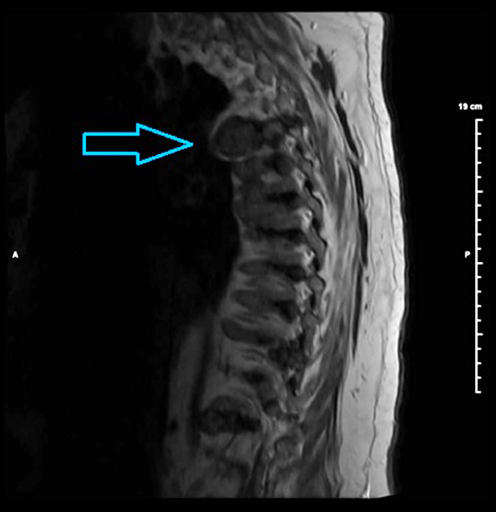 Magnetic resonance imaging of thoracic spine without contrast. Severe T4–5 central stenosis is likely associated with a disc bulge and protrusion. Focally abnormal cord signal can be seen with myelomalacia or contusion.