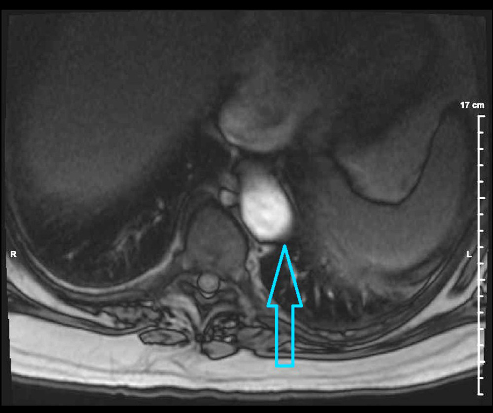 Magnetic resonance imaging of thoracic spine without contrast. Diffuse abnormal vertebral body marrow and T4-5 ventral mass lesion. Marrow replacing process such as hematopoietic malignancy, multiple leiomyoma, profound anemia, myelofibrosis, or other metastatic disease may be considered. Mass lesion is likely associated and is destructive of the ventral T4-5 level. Margins at the erosion are sclerotic and chronicity may be considered. Mass lesion may be seen in the setting of hematopoietic malignancy, extra medullary hematopoiesis, plasmacytoma, or other metastatic lesion.