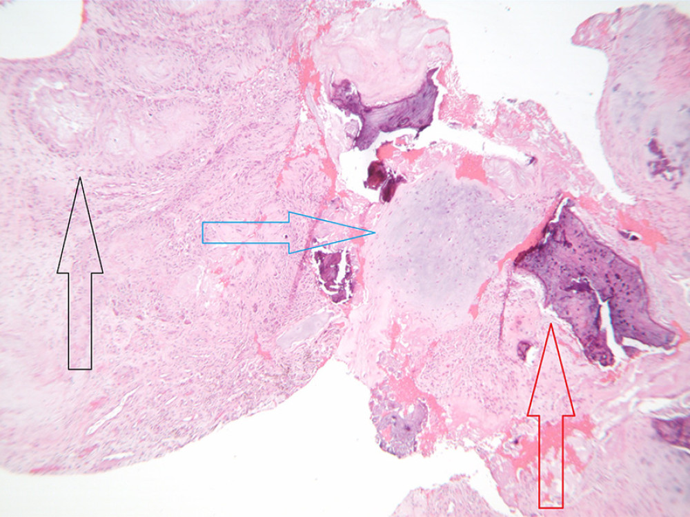 Pathology slide, hematoxylin and eosin stain. Low power view (50×) of bone (red arrow), cartilage (blue arrow), and gout (black arrow).