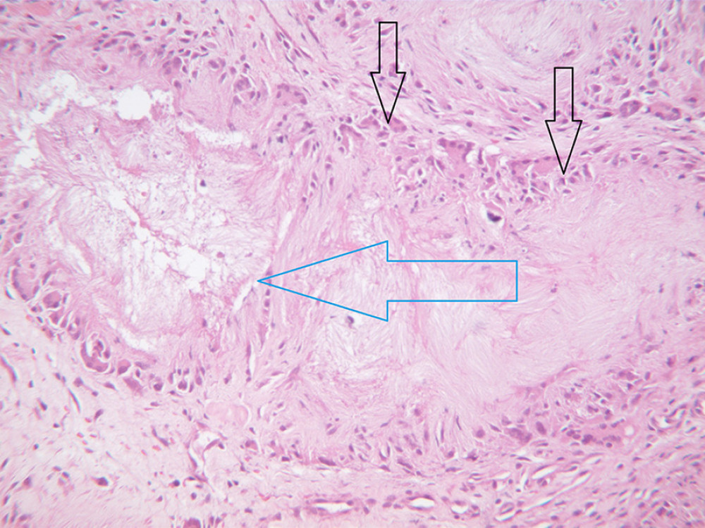 Pathology slide, hematoxylin and eosin stain. High power view (200×) of a tophaceous gout granuloma (big blue arrow), with foreign body giant cells and histocytes surrounding the uric acid crystals (small black arrows).