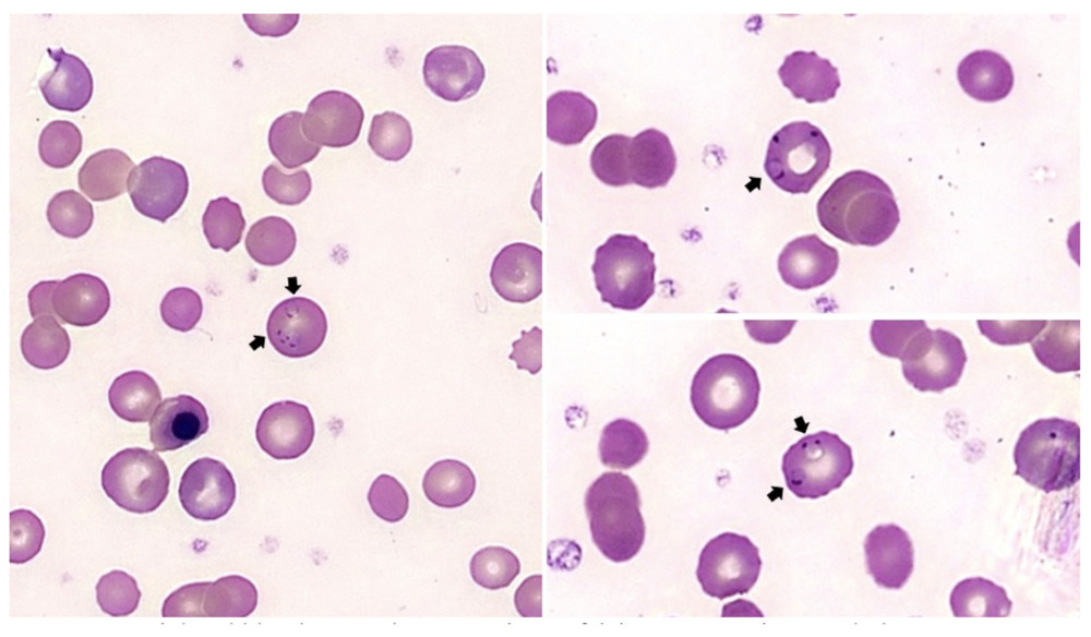 Peripheral blood smear demonstrating Plasmodium falciparum parasite morphology. Peripheral blood smear on presentation demonstrated P. falciparum in 1% of red blood cells (arrows).
