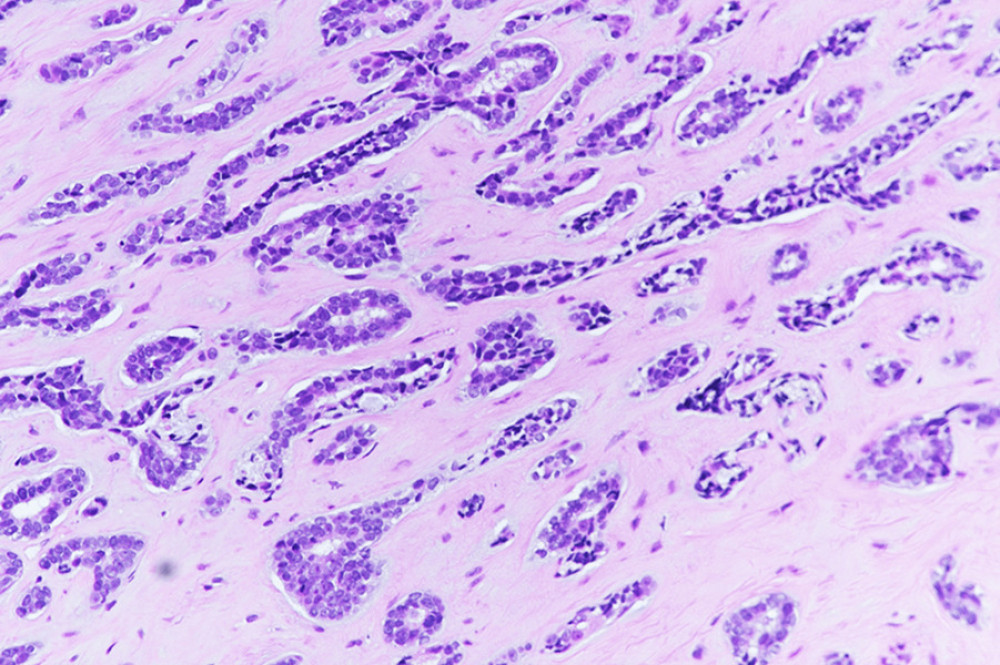 A photomicrograph of the nasopharyngeal biopsy showing intermediate- to high-grade adenoid cystic carcinoma with tubular, solid, and focal cribriform growth patterns.
