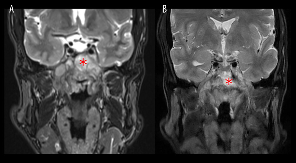 Coronal view of the mass in magnetic resonance imaging (red asterisk) at the time of diagnosis measuring 5.7×4.8×4.4 cm (A) and after 6 months of receiving chemoradiation (B).
