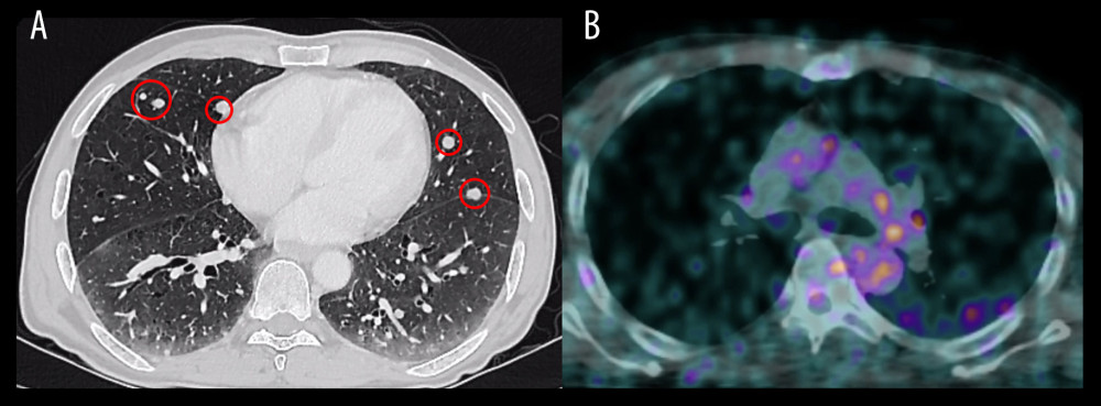 Axial view of the chest showing multiple bilateral lung nodules on computed tomography at the time of diagnosis (A) which decreased significantly in size and number on positron emission tomography after chemoradiation therapy (B).