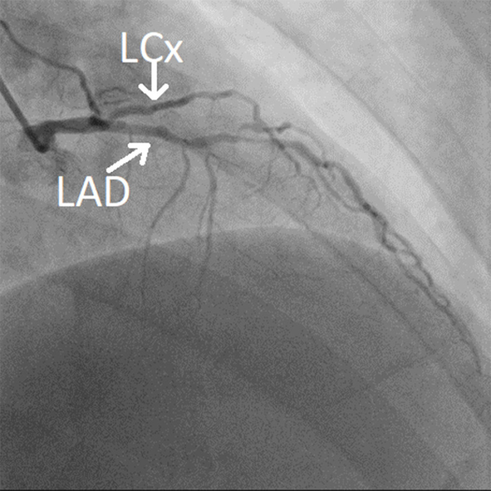 Case 1: Mid-left anterior descending artery chronic total occlusion and mid-left circumflex artery chronic total occlusion.