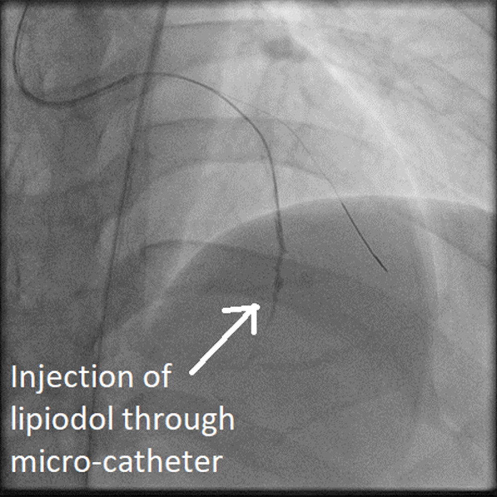 American Journal of Case Reports Two Cases of Management of Coronary
