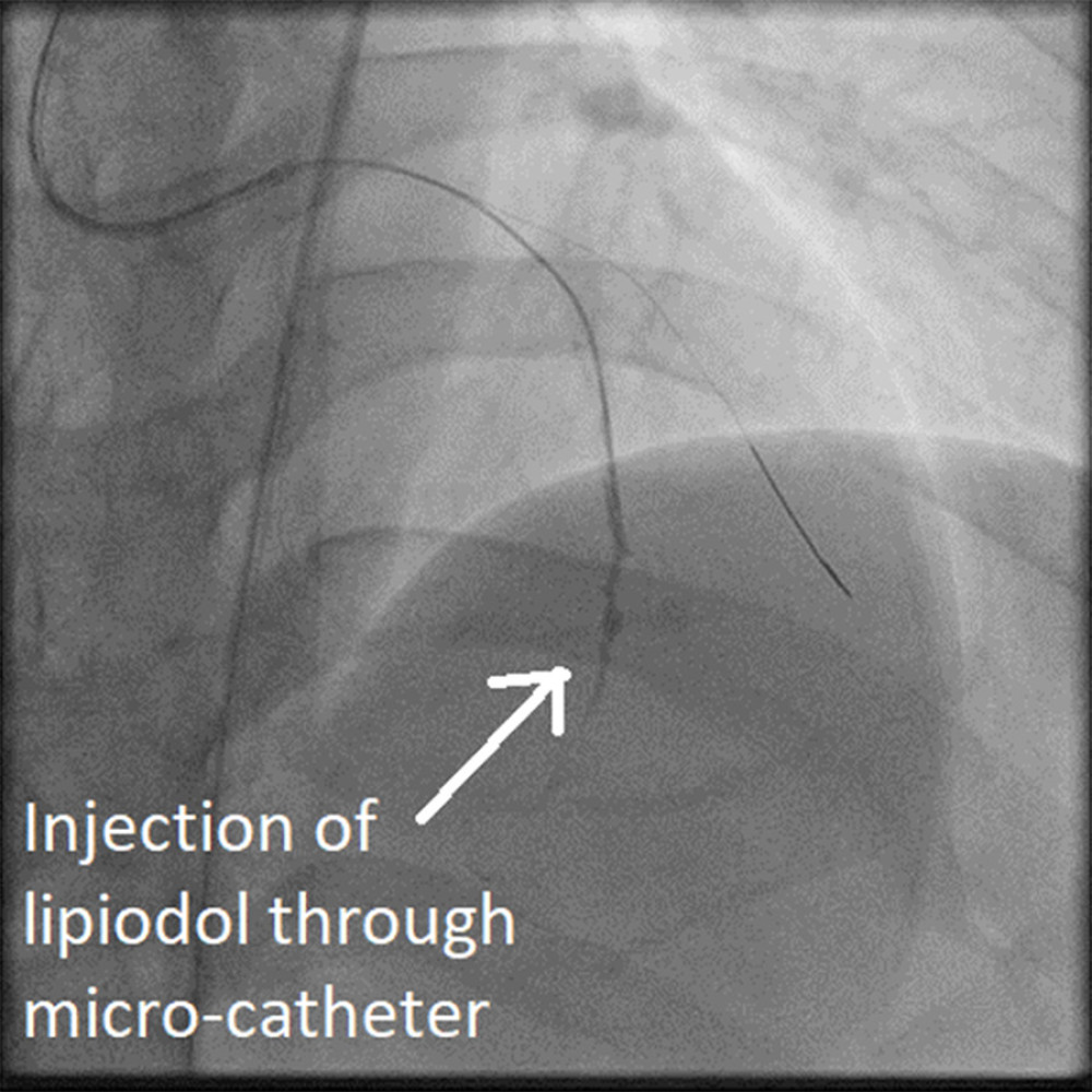 Case 1: Microcatheter in left anterior descending artery for injection of Histoacryl-Lipiodol mixture.