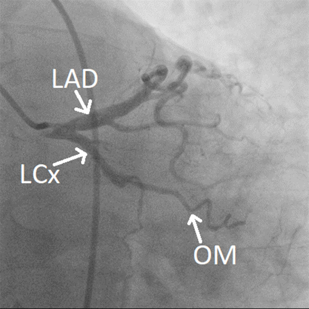Case 2: Mid-left circumflex artery chronic total occlusion collaterals from obtuse marginal branches.