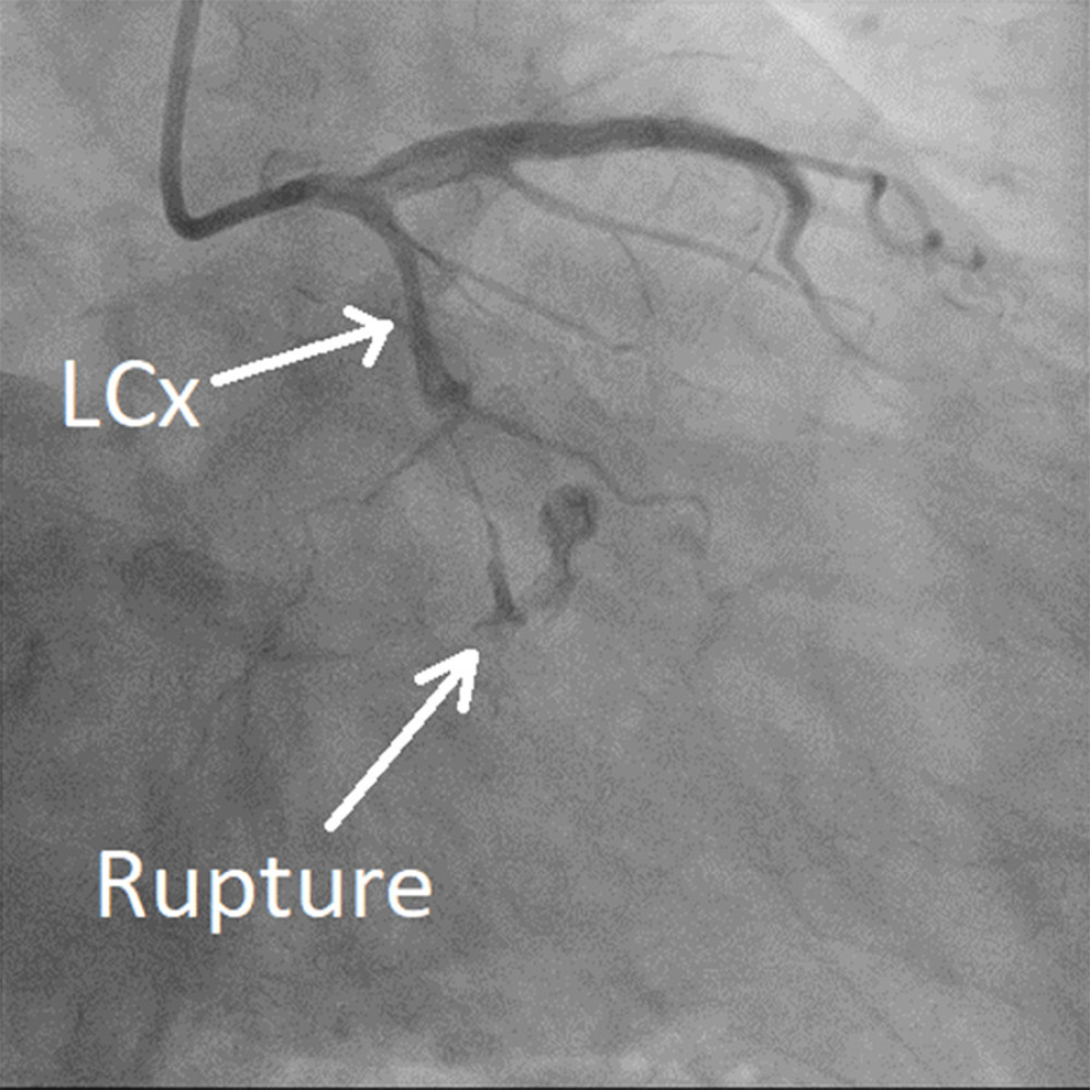 Case 2: Run-through wire crossed lesion, with multiple balloons. Angiogram showed left circumflex artery perforation with bleeding to epicardial space.