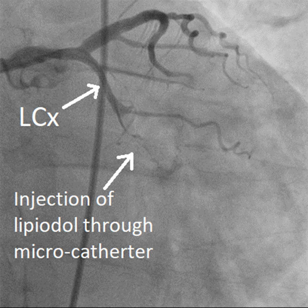 Case 2: Injection of Histoacryl-Lipiodol mixture through microcatheter into the false lumen.