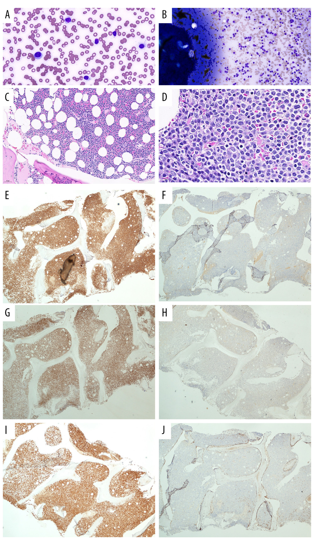 Morphological features of plasma cell leukemia. (A) The peripheral blood film shows lymphoplasmacytic cells and background rouleaux. (Wrights-Giemsa stain at 60× magnification). (B) The bone marrow aspiration is markedly hypercellular with increase in plasma cells. (May-Grunwald Giemsa stain at 20× magnification). (C, D) The trephine biopsy showed suppression of trilineage hematopoiesis and infiltration by neoplastic plasma cells, which have eccentric nucleus, chromatin arranged in a cog-wheel pattern and abundant basophilic-to-pinkish cytoplasm. (H&E stain at 20× and 60× magnification). (E) The neoplastic plasma cells are CD138-positive. (F) CD117-negative. (G) Lambda-light-chain-restricted. (H) Kappa light chain-negative. (I) Cyclin D1-positive. (J) CD56-negative. (Immunohistochemistry stain at 4× magnification)