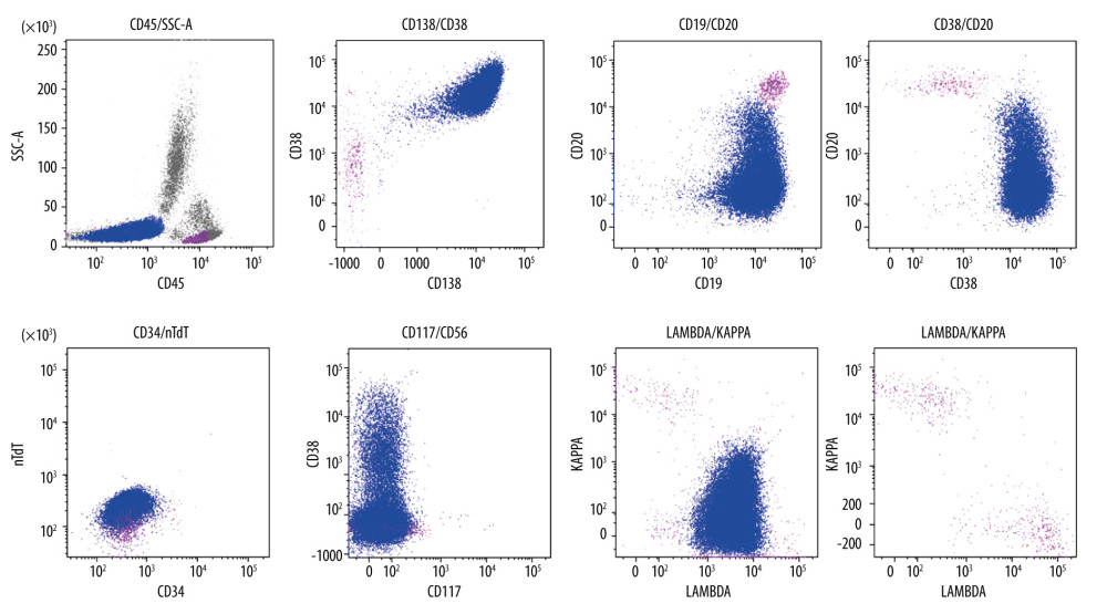 Flow cytometry analysis on peripheral blood, revealed a significant population of circulating plasma cells (blue) (65% of total analyzed cells). These circulating plasma cells were found in an SSC low/CD45 dim-negative gate, with strong expression of CD38 and CD138. Interestingly, these cells expressed CD19 and surface lambda and some plasma cells exhibited dim CD20 and CD56. There were polyclonal mature B lymphocytes (purple). These cells did not exhibit any markers of immaturity. Flow cytometry analysis of the bone marrow (not shown here) revealed similar proportions of plasma cells with the same immunophenotype.*Cells in the peripheral blood were characterized by flow cytometry using tubes to evaluate plasma cells (Tube 1), B cells (Tube 2), and blasts (Tube 3). Tube 1 (plasma cells): CD20-BB515 (Becton-Dickinson)/ CD117-PE (Biolegend)/ CD38-PerCPCy5.5 (Biolegend)/ CD19-PECy7 (Biolegend)/ CD138-APC (Biolegend)/ CD45-APCFire750 (Biolegend)/ CD56-BV421 (Biolegend). Tube 2 (B cells): CD79b-FITC (Biolegend)/ slambda-PE (Dako)/ CD20-PerCPCy5.5 (Biolegend)/ CD19-PECy7 (Biolegend)/ skappa-APC (Dako)/ CD10-APCFire750 (Biolegend)/ CD5-BV421 (Biolegend)/ CD3-BV510 (Biolegend). Tube 3 (cytoplasmic blasts): nTdT-FITC (Dako)/ cIgM-PE (Dako)/ HLA-DR-PerCPCy5.5/ CD10-PECy7 (Biolegend)/ CD7-APC (Biolegend)/ CD45-APCFire750 (Biolegend)/ CD19-BV421 (Biolegend)/ CD34-BV510 (Biolegend).
