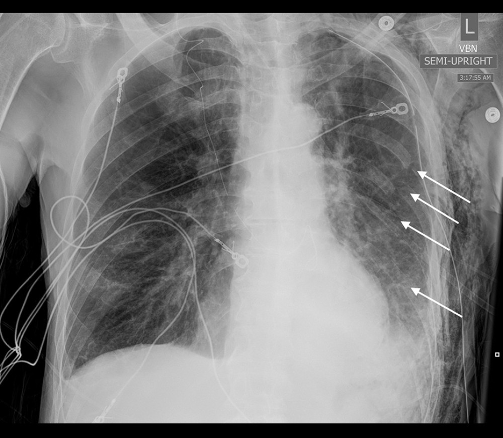 Portable, anterior-posterior chest X-ray from hospital day 2, which demonstrates some of the patient’s left-sided rib fractures; in particular, left 5th–8th rib fractures can be seen in this X-ray, denoted with white arrows.