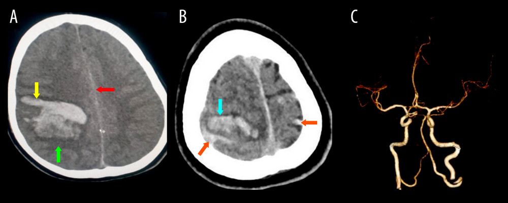 (A) Non-contrast computed tomography (NCCT) head axial shows intraparenchymal hemorrhage in the right frontoparietal region (yellow arrow) with perilesional edema (green arrow) and mild midline shift towards the contralateral side (red arrow); (B) Axial CT showing intraparenchymal hemorrhage in the right frontoparietal region (blue arrow) with mild bilateral subarachnoid hemorrhage (orange arrows); (C) CT angiography volume-rendering image shows no significant abnormality.