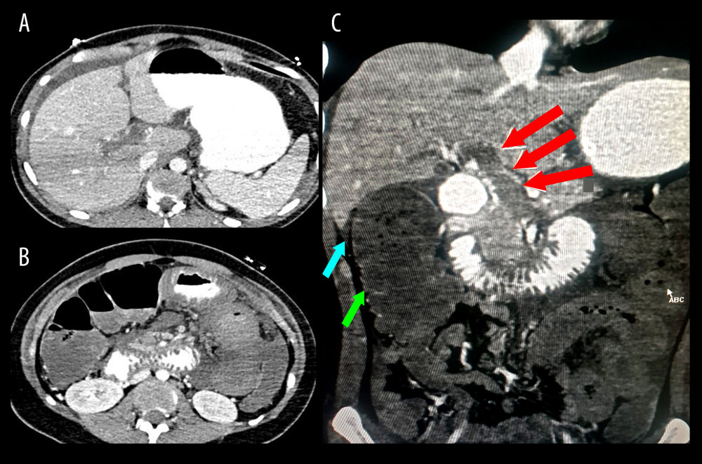 Contrast enhanced abdominal CT axial (A, B) and coronal (C) imaging shows significant thrombosis in the portal vein (red arrow) with dilatation of the portal vein and mild ascites (blue arrow). No significant enhancement of the bowel wall is noted, thereby suggestive of ischemic bowel (green arrow).