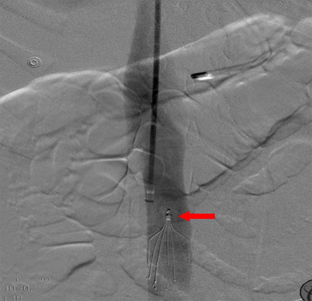 Fluoroscopic image of IVC (inferior vena cava) venogram shows deployment of the IVC filter (red arrow) in the optimal position.