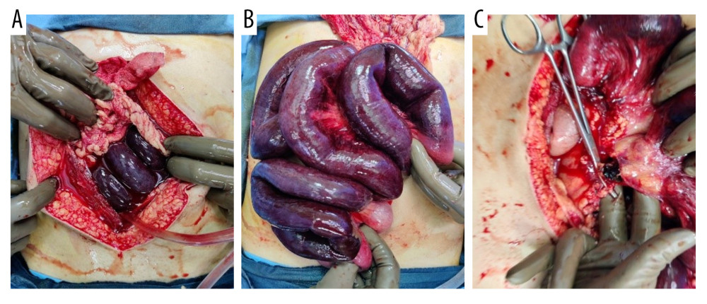 (A-C) Photographs from the surgical resection and anastomosis of the affected small bowel. A peritoneal lavage was also performed for the massive gut gangrene.