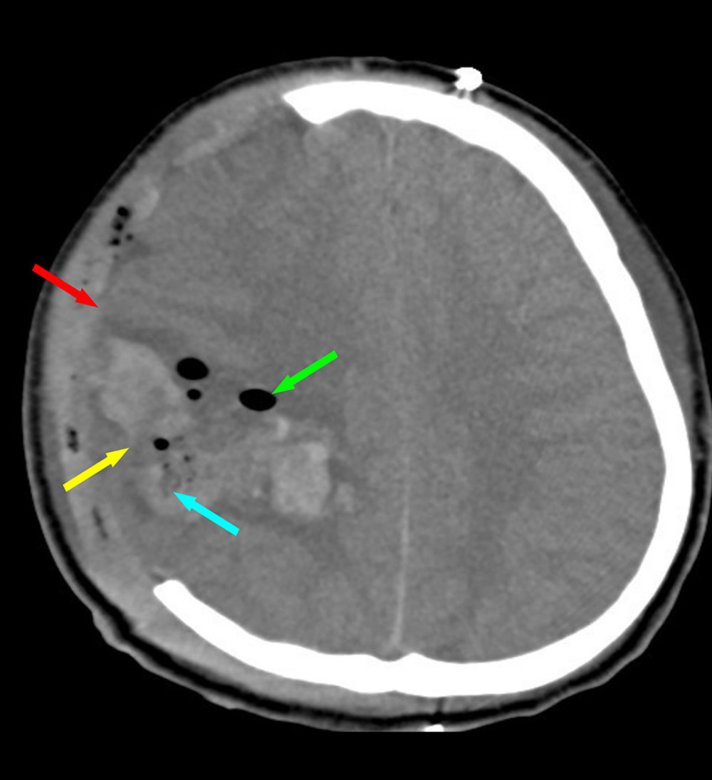 Non-contrast CT (NCCT) head axial shows right craniectomy (red arrow) with residual intraparenchymal changes (yellow arrow) and post-operative changes in the form of cystic encephalomalacia (blue arrow) in right parietal lobe and pneumocephalus (green arrow).