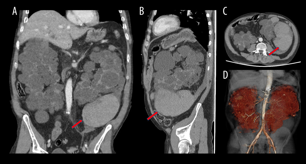 (A–D) Computed tomography (CT) angiogram of abdomen/pelvis demonstrating a large left retroperitoneal hematoma (arrows) in addition to bilaterally enlarged polycystic kidney consistent with the diagnosis of autosomal dominant polycystic kidney disease.
