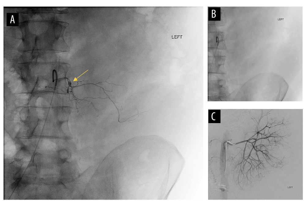 Selective left L3 lumbar arteriogram (A) demonstrating irregular vessels and a small focus of active bleeding (arrow). This left L3 lumbar artery was embolized to statis with Gelfoam, and subsequent injection showed no flow (B). The left renal artery angiogram showed an enlarged kidney with irregular vessels but no focus of active hemorrhage (C).