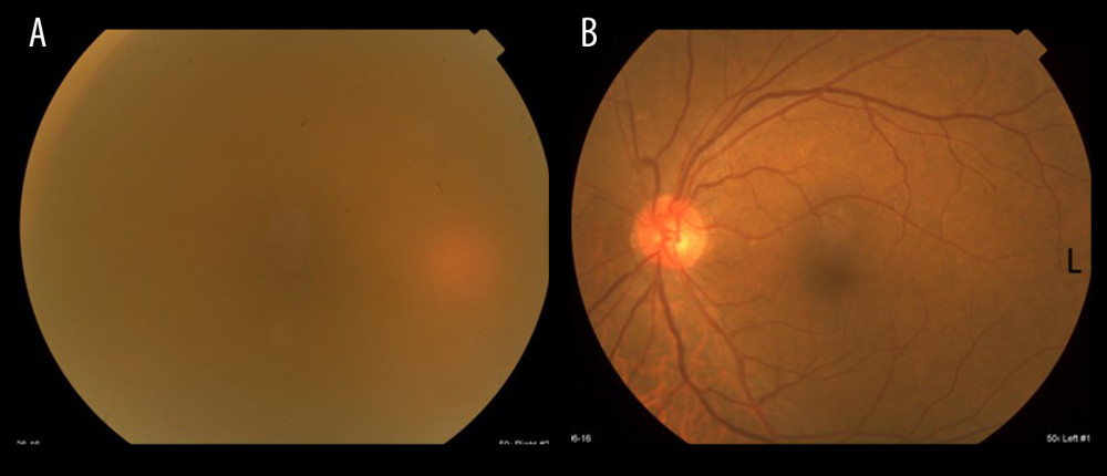 In the right eye, fundoscopy shows diffuse opacity of vitreous body and cannot show ocular fundus by decreased permeability (A, right eye; B, left eye).