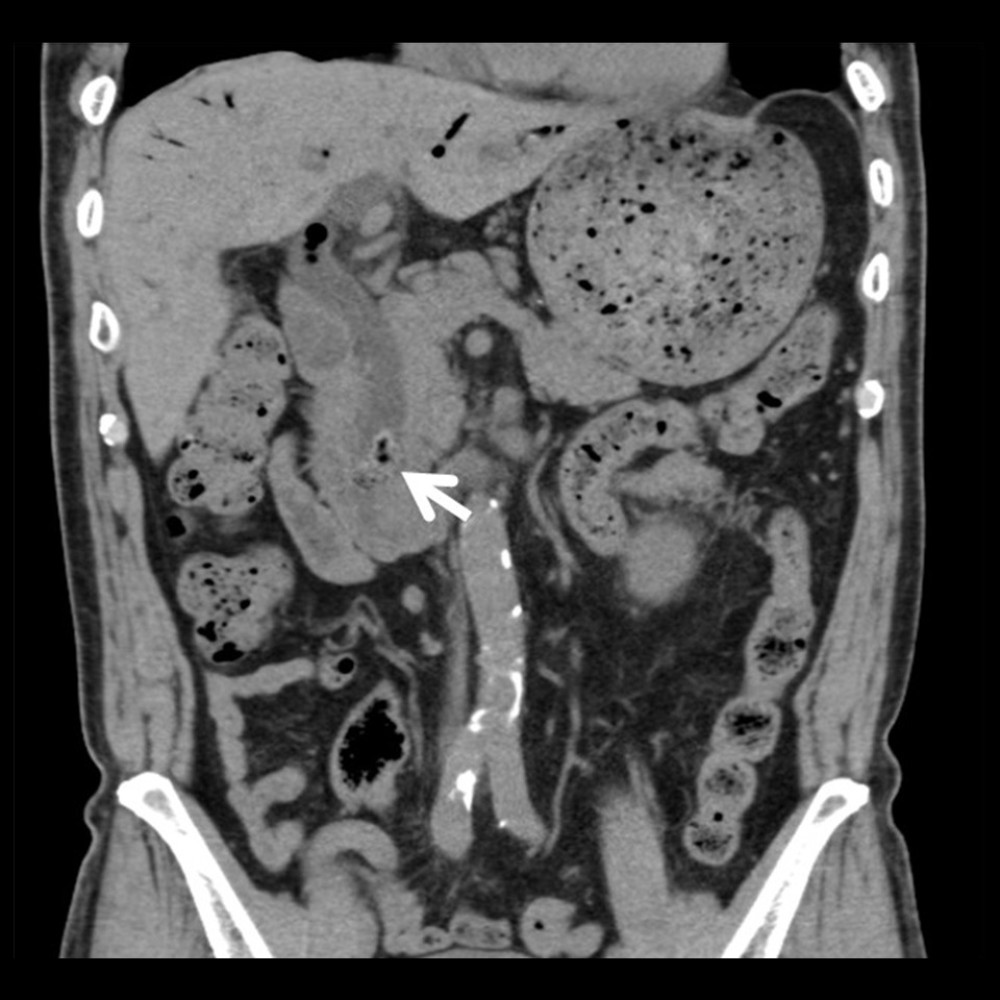 Abdominal CT reveals a mass of diameter 24 mm, which is suspected to be choledocholith (arrow), in the duodenal end of the common bile duct.