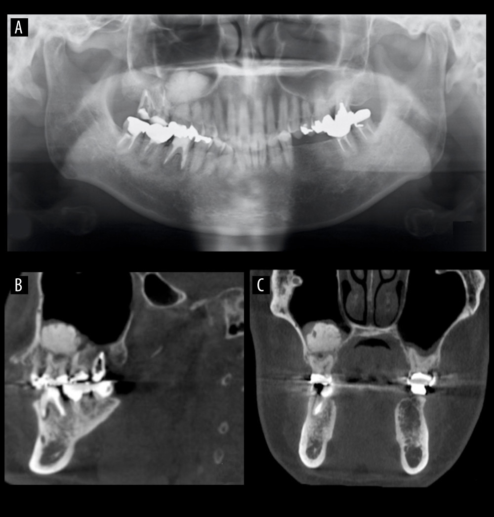 (A) Panoramic radiograph showing radiopaque image in the right maxillary sinus. (B) CT image (sagittal) showing that the lesion is discontinuous with the root. (C) CT image (coronal) showing that the lesion is free from the lateral and inferior wall of the maxillary sinus. CT – computed tomography.