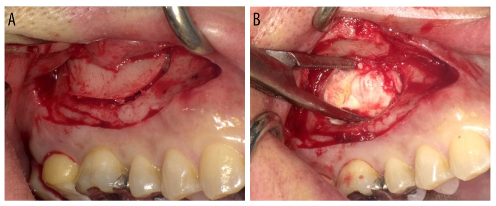 (A) Caldwell-Luc method to open the anterior wall of the maxillary sinus. (B) Removal of the free osteoma from the open window area.