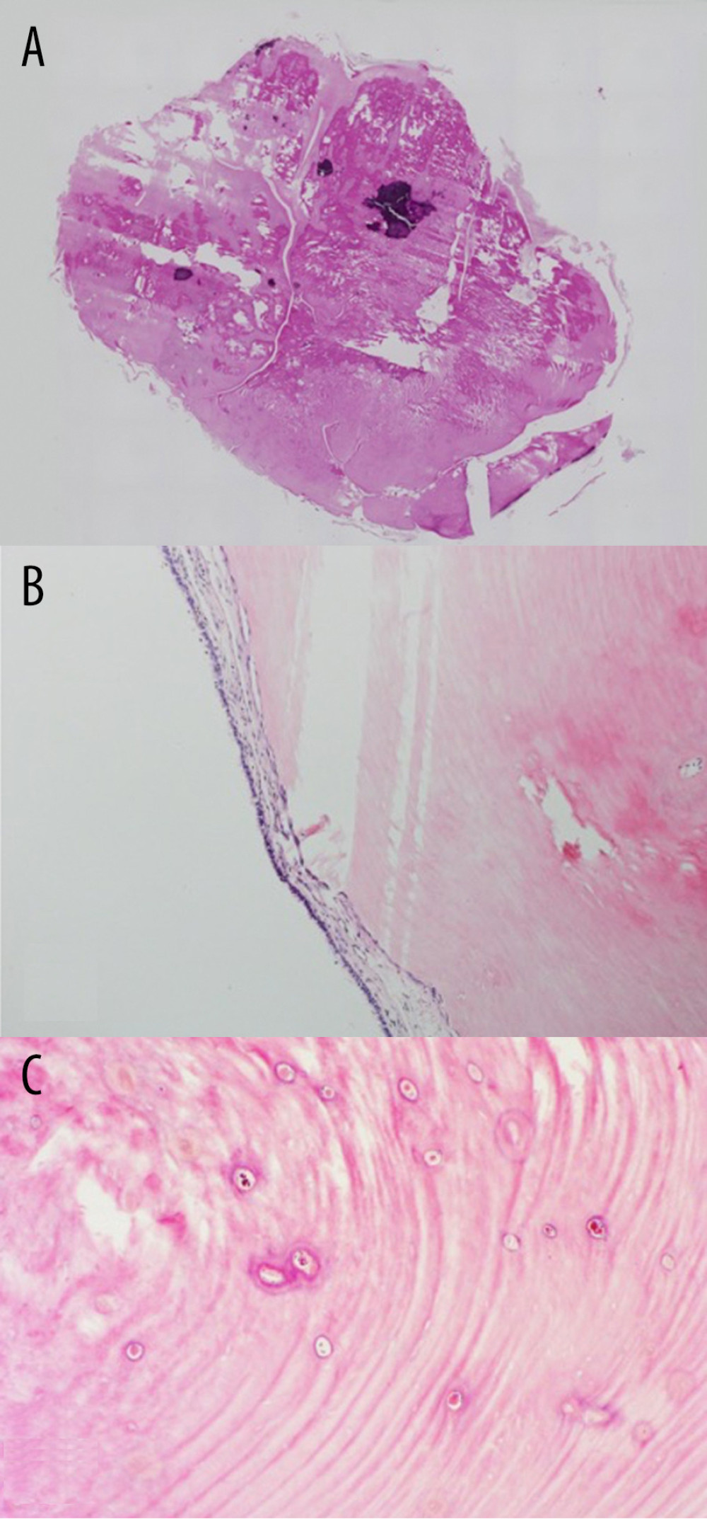 Histopathology with hematoxylin and eosin staining. (A) Loupe image of excised osteoma (reconstructed segmented section). (B) Low magnification (×40). Atrophic maxillary sinus mucosa can be seen on the osteoma surface. (C) High magnification (×200). Dense osteoma composed of dense laminar plate bone with poor bone marrow cavity.