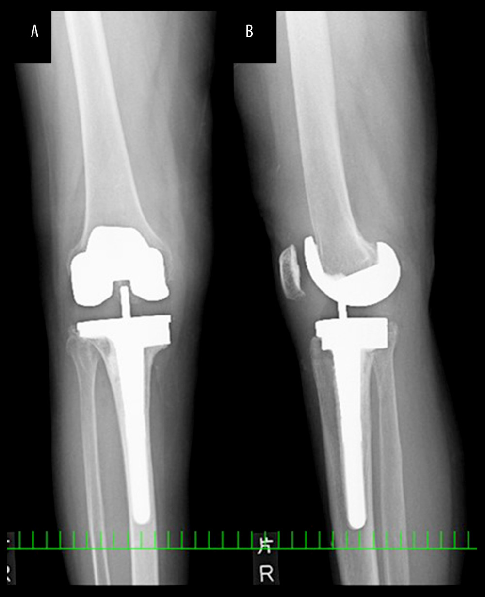Radiograph of the right knee at the onset of the infection, anteroposterior (A) and lateral (B) views. The radiograph shows no osteolytic lesions and no signs of periprosthetic loosening.