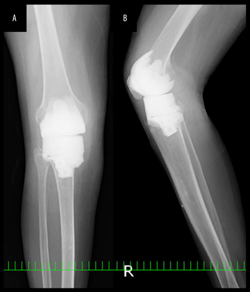 Radiograph of the right knee after the second surgery, anteroposterior (A) and lateral (B) views. Irrigation, debridement, implant removal, and antibiotic spacer placement were performed as the second surgery after eradication failure of infection.