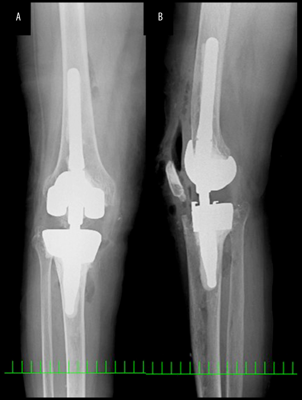 Radiograph of the right knee after the final surgery, anteroposterior (A) and lateral (B) views. One and a half years after the second surgery, the patient underwent re-revision total knee arthroplasty.