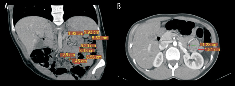 Preoperative CT – (A) – frontal reconstruction. Polypoid formation, obturating to a significant extent the lumen of the intestine with a length of 8.56 cm. Enlarged mesenteric lymph nodes; (B) – transverse reconstruction. Polypoid formation, obturating to a significant extent the lumen of the intestine with a diameter of 3.23 cm. Enlarged mesenteric lymph node.