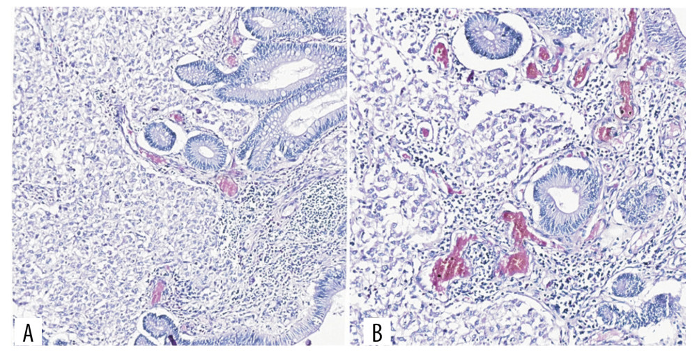 Representative image of hematoxylin and eosin staining of the tumor (scanning microscopy). (A, B) Stromal infiltration of polygonal tumor cells with pronounced cohesion, invading the colorectal mucosa.
