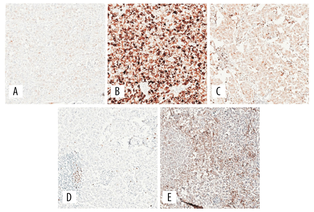 Immunohistochemical examination of a material taken from the formation of the colon during colonoscopy (paraffin block № 11256/17). (A) Cells are stained for Melan A; (B) cells are stained for HMB 45; (C) cells are stained for S 100; (D) cells are stained for Ki-67; (E) cells are stained for PD-L1.